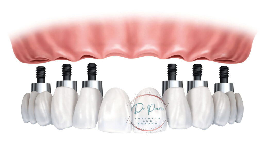 all on 6 dental implants cost in india
