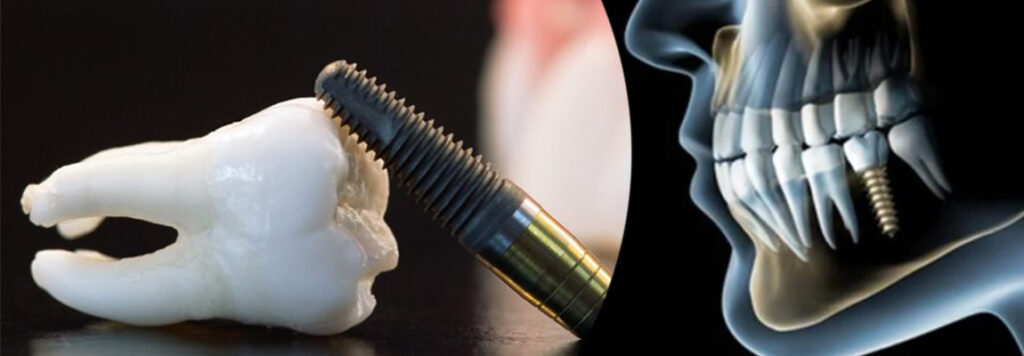 Dental Implant Clinics in Dubai:
